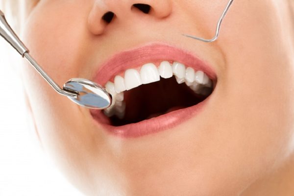 Mitos sobre las caries